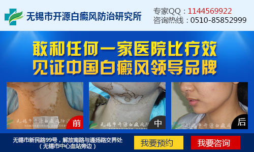 无锡治疗白斑