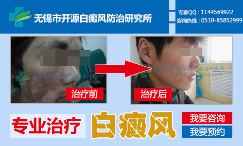 无锡哪家医院治白殿风最好