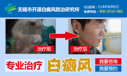 无锡市开源白癜风防治研究所